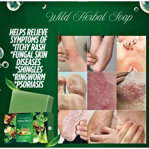 Anti-itch soap, herbal soap, wild herbal soap, reduces rashes, itching, treats skin allergies, acne on the back, blisters, bumps